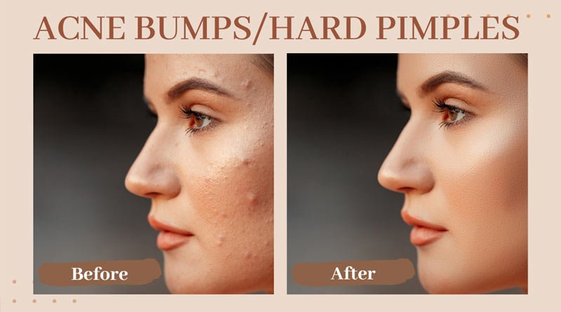 Simple Daily Habits to Stop Pimples on Your Face