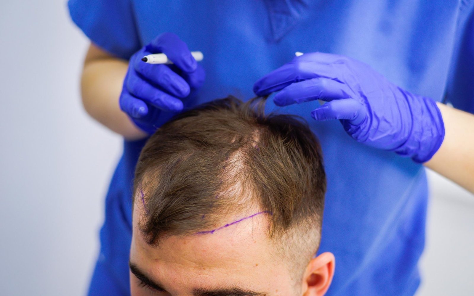 BEST SURGEON FOR HAIR TRANSPLANT IN ISLAMABAD PAKISTAN